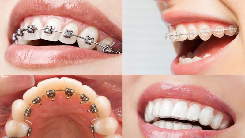 Niềng răng hô mất bao lâu và quy trình diễn ra cụ thể như thế nào? 2