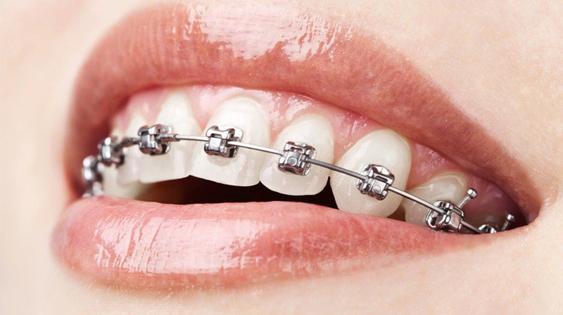 Niềng răng mắc cài kim loại được chia thành nhiều loại khác nhau và có những ưu nhược điểm riêng