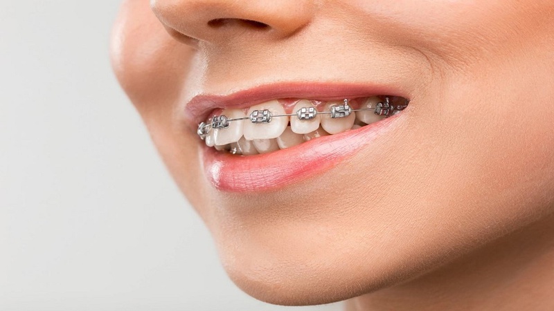 Niềng răng mắc cài kim loại là một trong những kỹ thuật chỉnh nha phổ biến trong nhiều cơ sở nha khoa