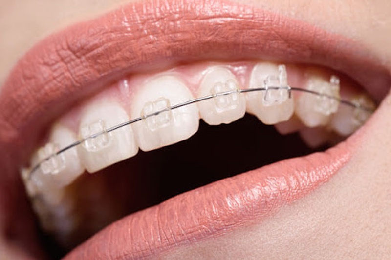 Niềng răng mắc cài trong suốt giá bao nhiêu và có hiệu quả không 1