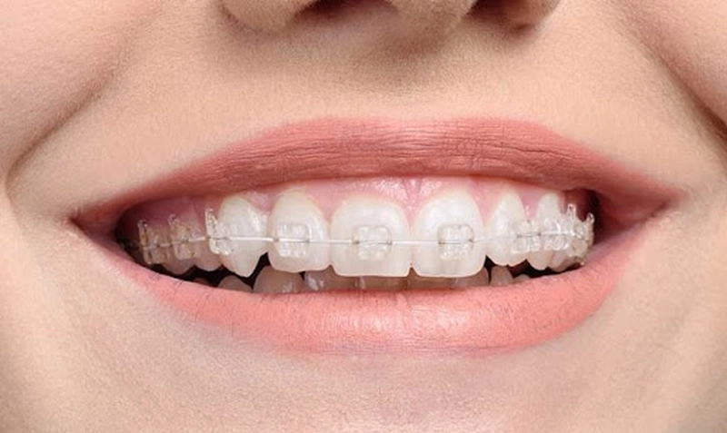 Niềng Răng Mắc Cài Trong Suốt Giá Bao Nhiêu Và Có Hiệu Quả Không 2