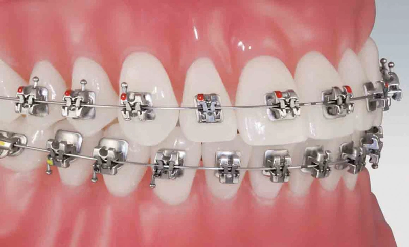 Niềng răng có chụp MRI được không và một vài lưu ý 2