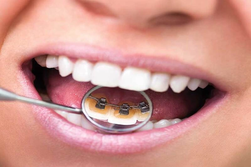 Niềng răng mặt trong giá cả như thế nào? Những lưu ý về phương pháp này 4