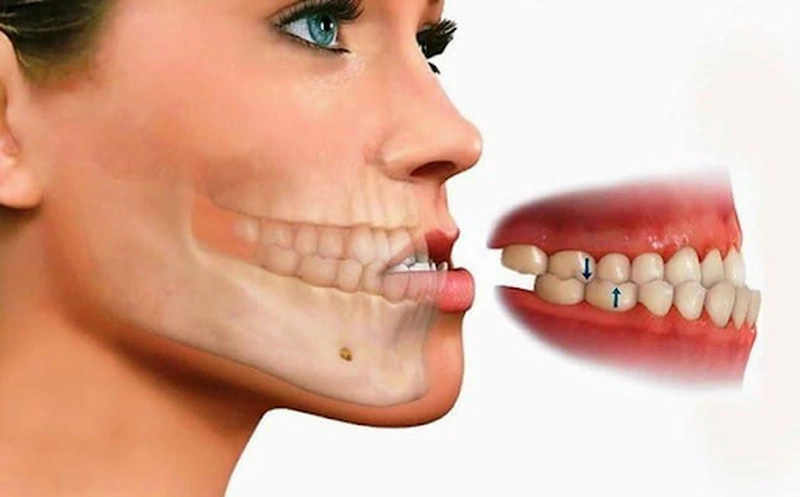 Niềng răng móm bao nhiêu tiền? Những điều cần nên biết