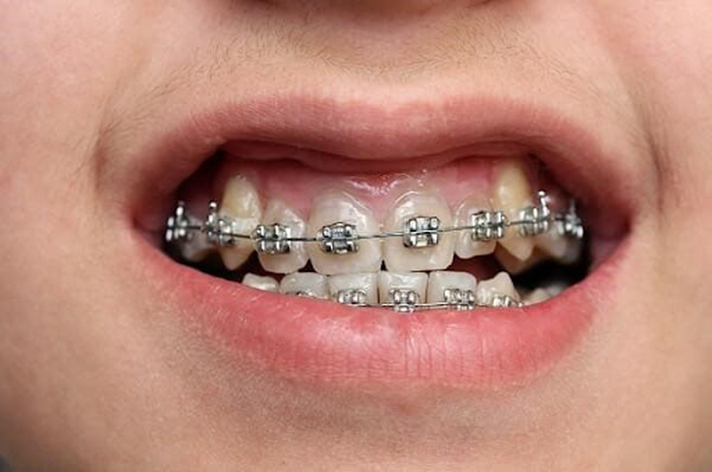 Niềng răng móm bao nhiêu tiền? Những điều cần nên biết