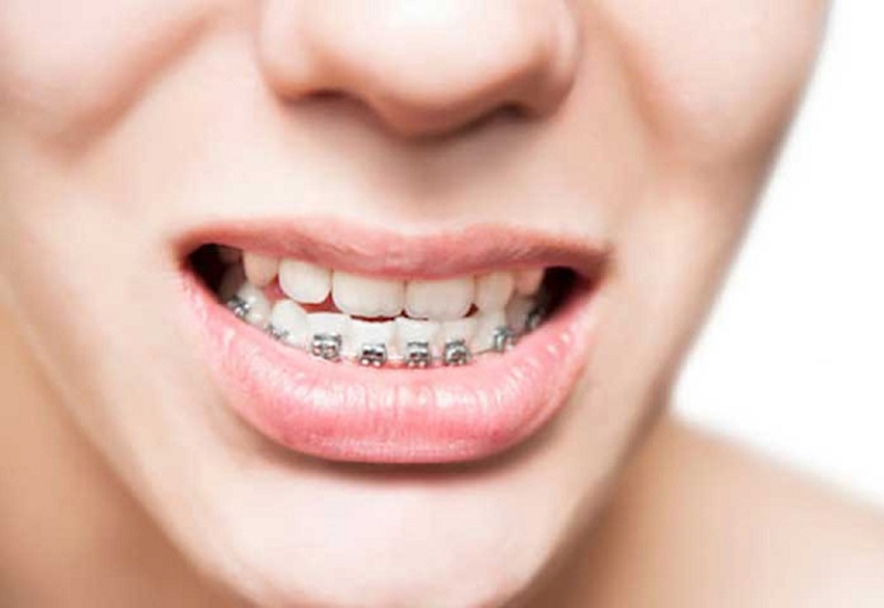 Niềng răng móm bao nhiêu tiền? Những điều cần nên biết