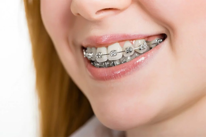 Niềng răng móm bao nhiêu tiền? Những điều cần nên biết