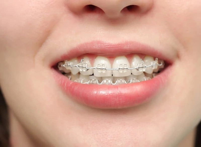 Góc giải đáp: Niềng răng mũi có cao lên không?
