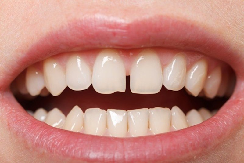 Góc giải đáp: Niềng răng thưa 1 hàm giá bao nhiêu tiền?