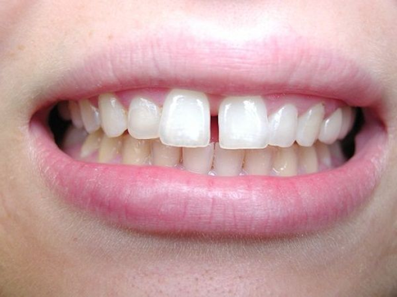 Góc giải đáp: Niềng răng thưa 1 hàm giá bao nhiêu tiền?