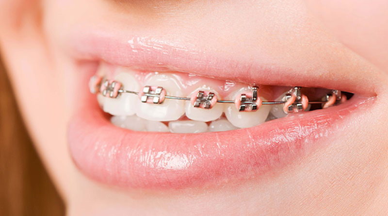 Góc giải đáp: Niềng răng thưa 1 hàm giá bao nhiêu tiền?