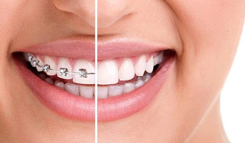 Niềng Răng Là Gì? Niềng Răng Trả Góp Là Gì?