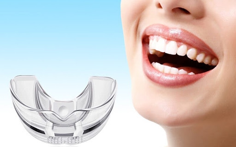 Những Chia Sẻ Về Niềng Răng Trainer