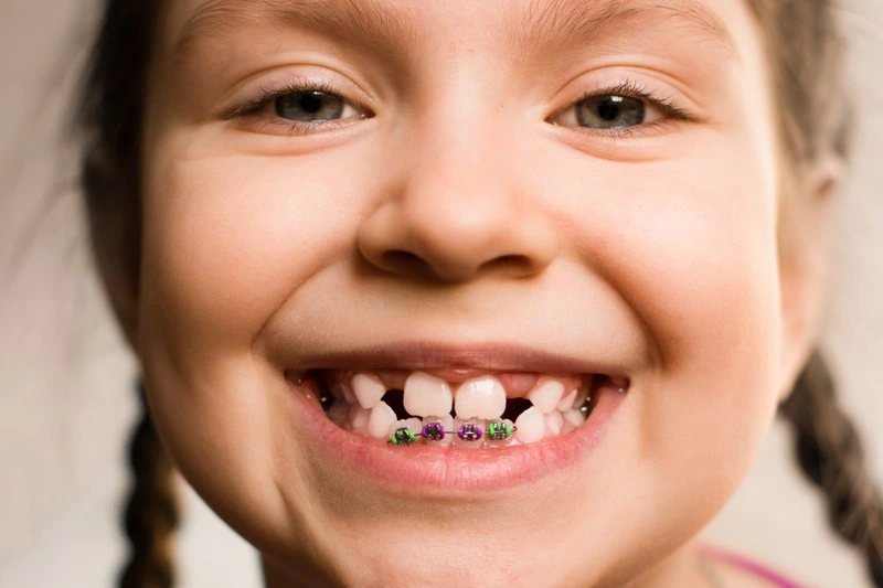 Những điều mà bạn không thể bỏ qua về niềng răng trẻ em 2