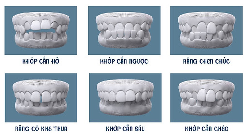 Giải đáp thắc mắc vấn đề niềng răng trong suốt giá bao nhiêu cho bạn nào chưa biết 2