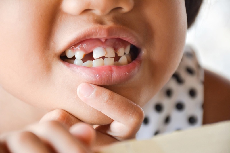 Nỗi lo trẻ mất răng sữa sớm phải làm sao? 3