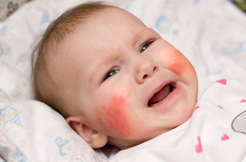 Nổi mề đay dị ứng ở trẻ có nguy hiểm không?