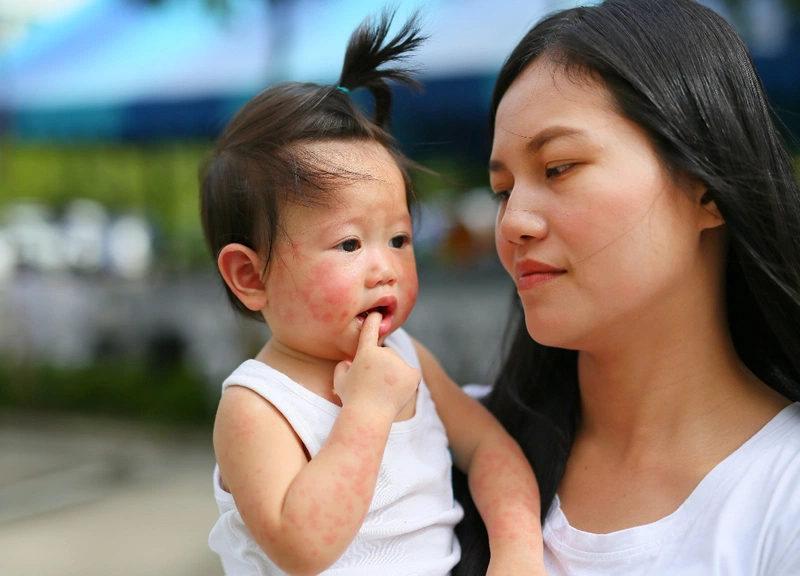 Nổi mề đay dị ứng ở trẻ có nguy hiểm không?