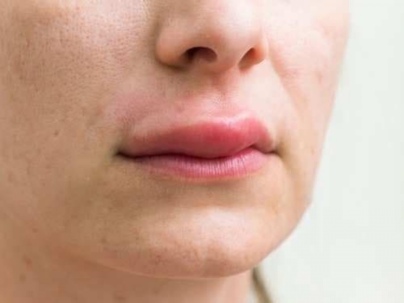 Nổi mề đay sưng môi là bệnh gì? Căn nguyên và cách xử trí