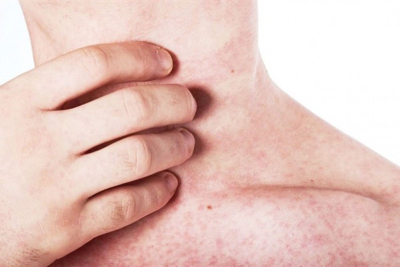 Hầu hết các tình trạng nổi rôm mùa hè đều tự biến mất trong vài ngày