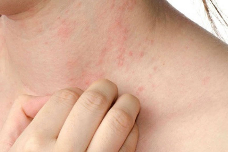 Thông thường, tình trạng nổi rôm sảy khi mang thai chỉ kéo dài trong 3-5 ngày