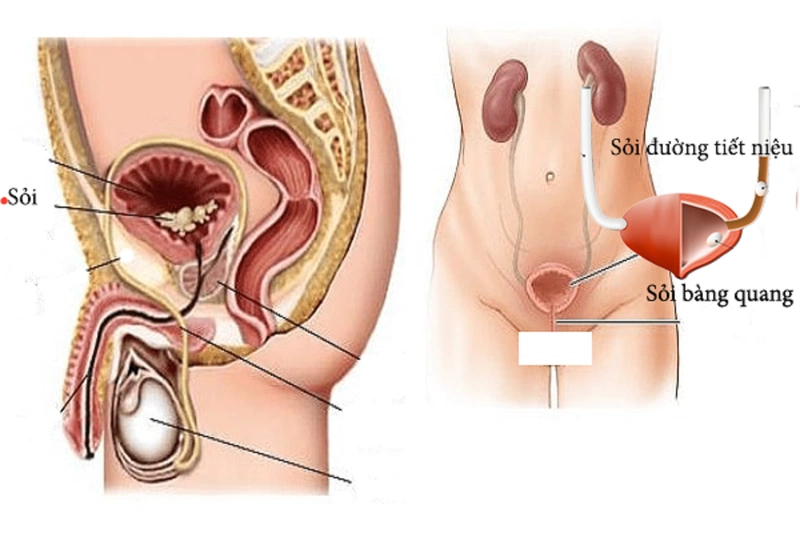 Nội soi bàng quang là phương pháp giúp các bác sĩ khảo sát đường tiểu dưới