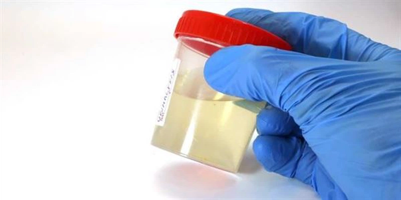 Lý giải hiện tượng nước tiểu đục có cặn trắng 1
