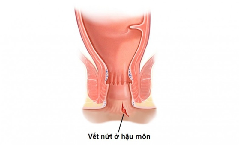 Nguyên nhân gây ra nứt hậu môn sau sinh và cách xử lý 1