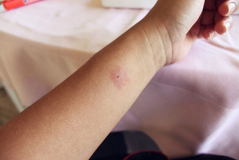 Cách sơ cứu và chữa trị khi bị ong đốt nhanh hết sưng tại nhà hiệu quả  Sở  Y tế Nam Định