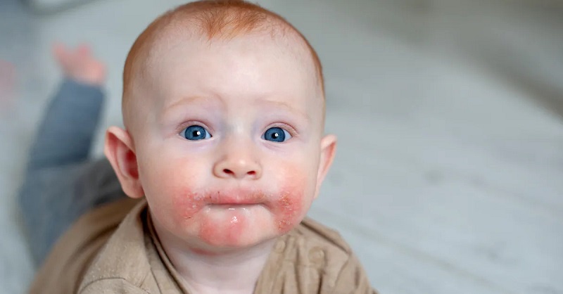 Phải làm thế nào khi trẻ sơ sinh dị ứng sữa mẹ? 3