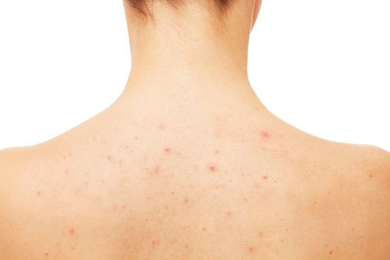 Papulex lotion mua ở đâu? Nơi bán uy tín 1