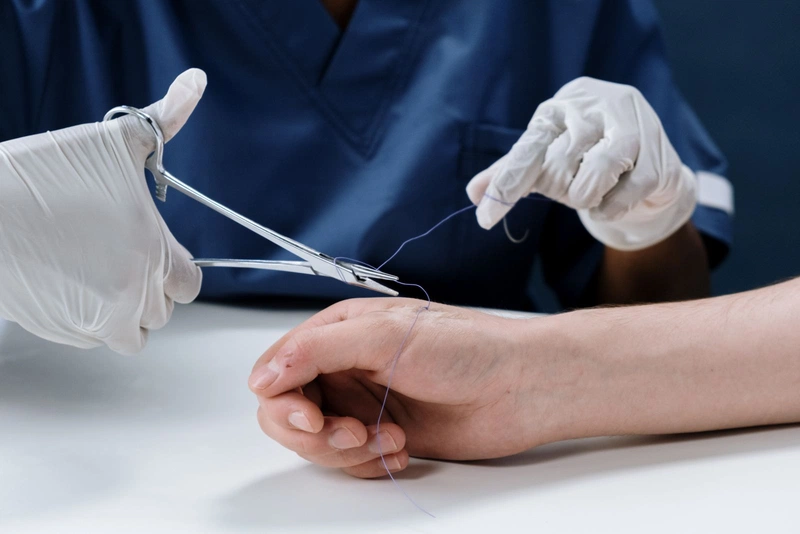Cách chăm sóc vết thương sau khi cắt chỉ 1