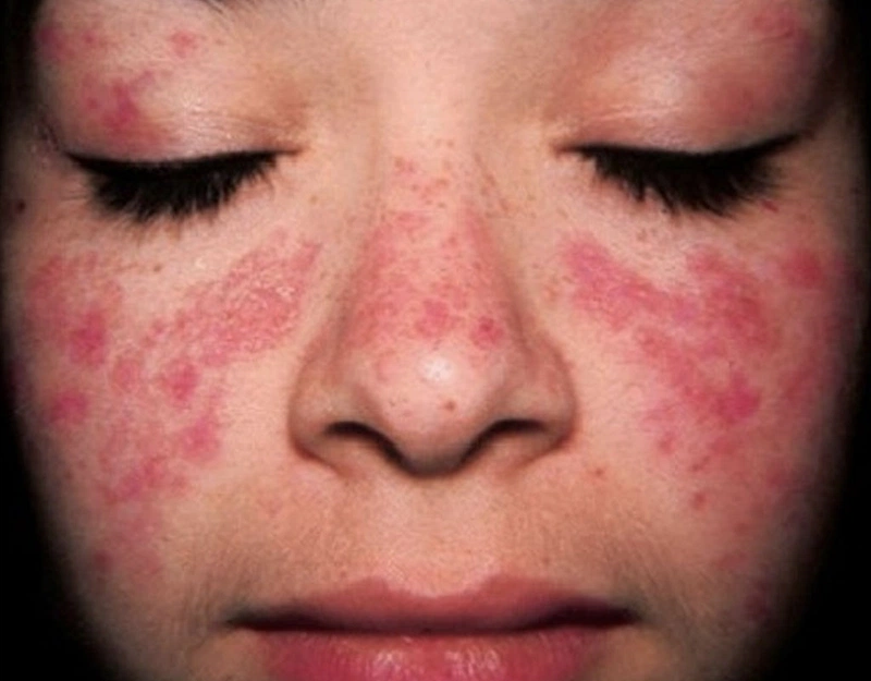 Phác đồ tiếp cận lupus ban đỏ hệ thống ở người trẻ mà bạn nên biết 1