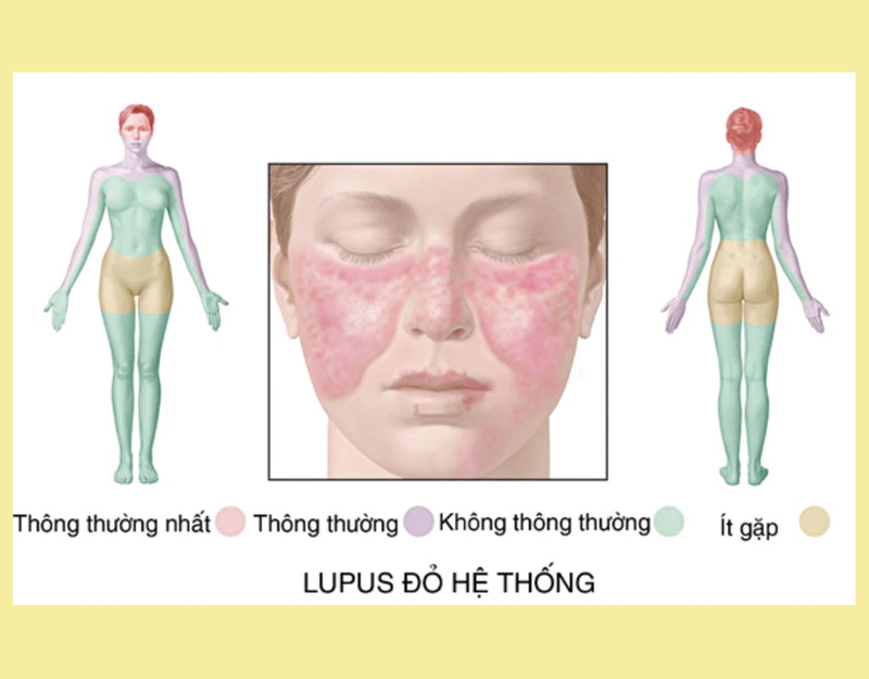 Phác đồ tiếp cận lupus ban đỏ hệ thống ở người trẻ mà bạn nên biết 2