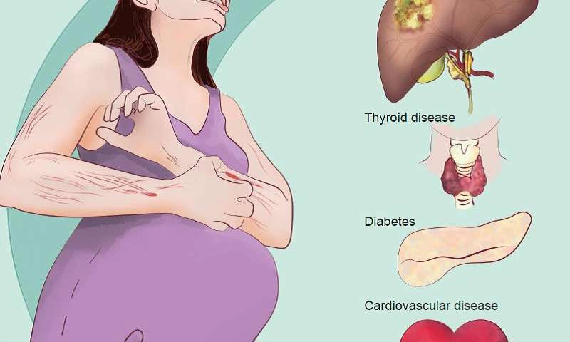 Phải làm gì khi bị ứ mật thai kỳ? 1