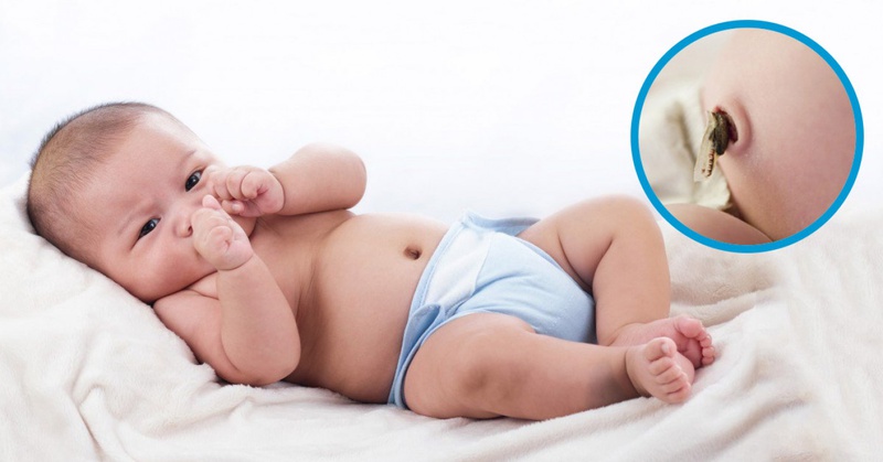 Nếu rốn trẻ sơ sinh có mủ trắng hay mủ vàng thì mẹ cần thận trọng vì đây chính là dấu hiệu viêm nhiễm rốn