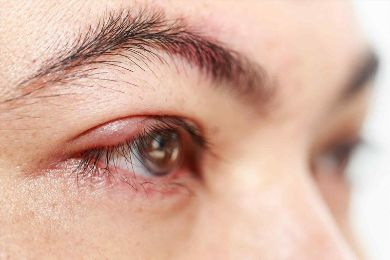 Phải làm sao để xử lý triệu chứng đau mắt đỏ bị sưng gây khó chịu 1