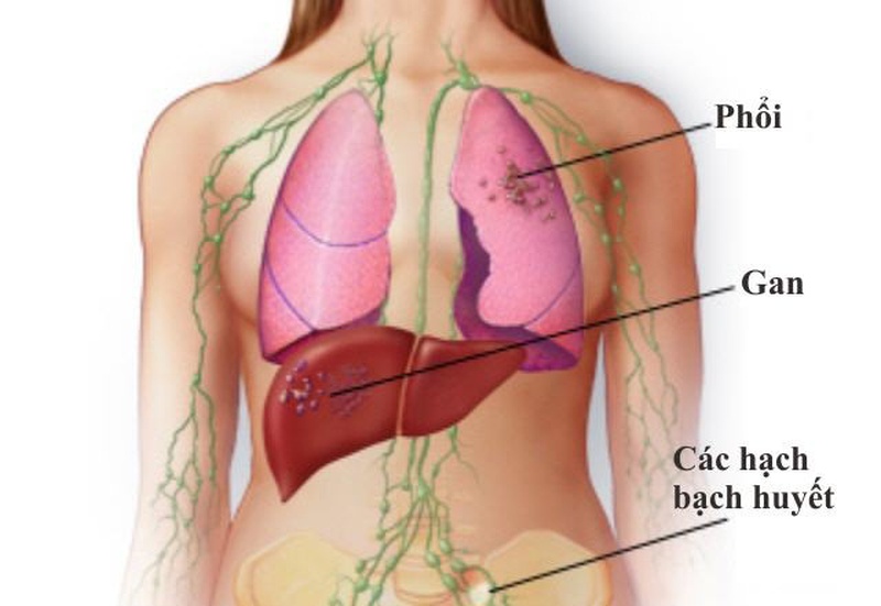 Phân biệt các triệu chứng ung thư phổi di căn 3