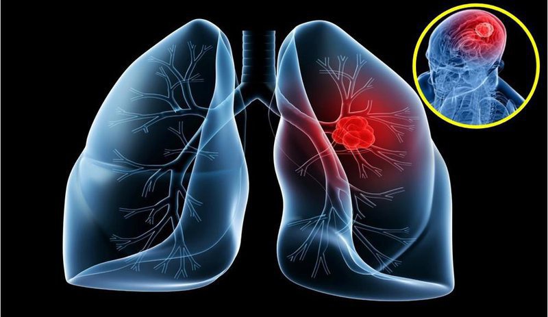 Phân biệt các triệu chứng ung thư phổi di căn 4