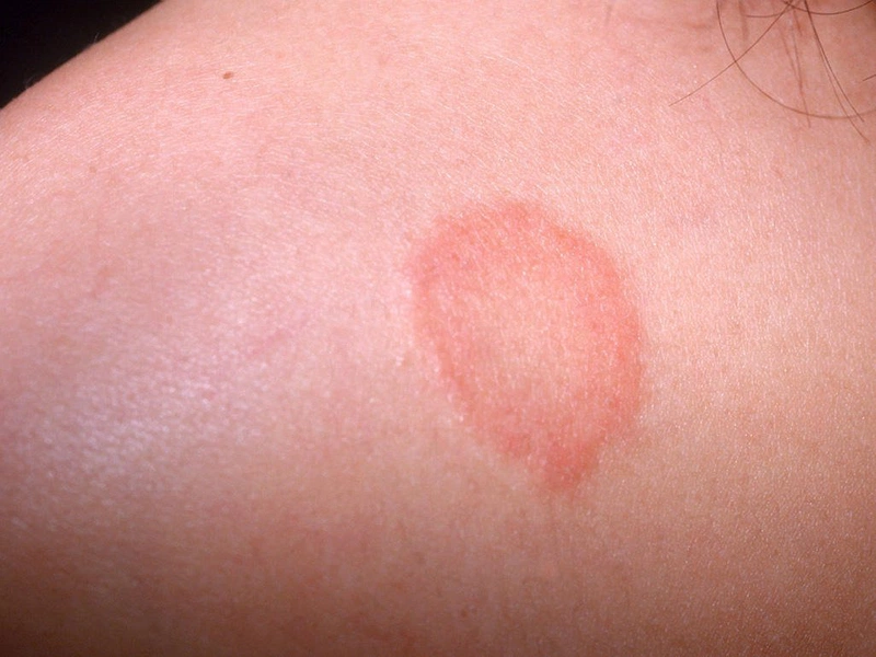 Phân biệt eczema và hắc lào như thế nào 2