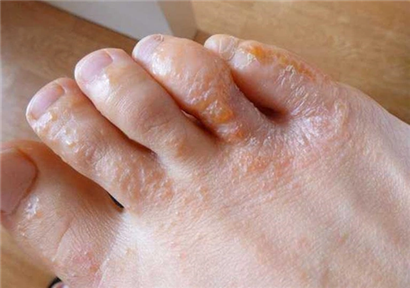 Phân biệt hắc lào, tổ đỉa: Nguyên nhân, triệu chứng và cách điều trị 4