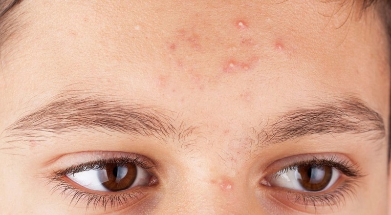 Phân biệt những loại mụn trên da 1