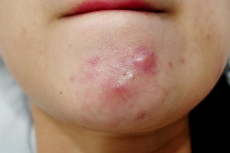 Phân biệt những loại mụn trên da 3