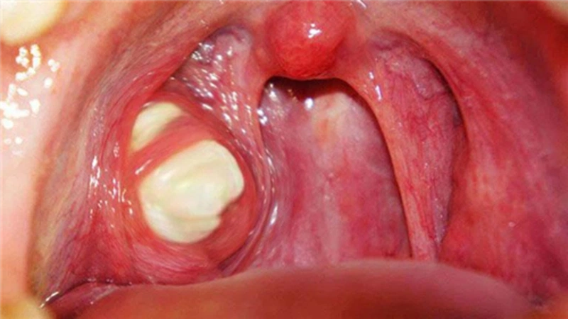Phân biệt ung thư vòm họng và viêm amidan có mủ như thế nào? 2
