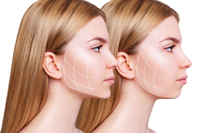 Phân loại độn cằm sụn Hàn Quốc1
