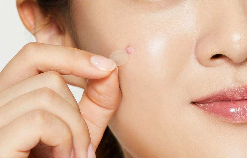 Phân loại miếng dán mụn và cách sử dụng hiệu quả