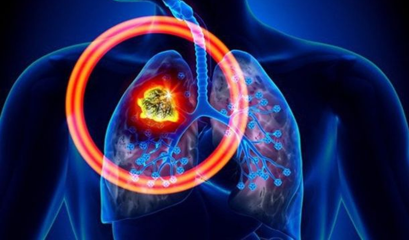 Ung thư phổi tế bào nhỏ giai đoạn giới hạn