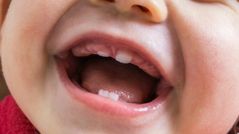 Phanh môi bám thấp là gì? Khi nào nên đưa trẻ đi cắt phanh môi ...