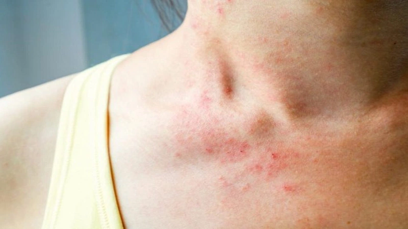 Những điều bạn cần biết về tình trạng mụn nổi ở ngực 1