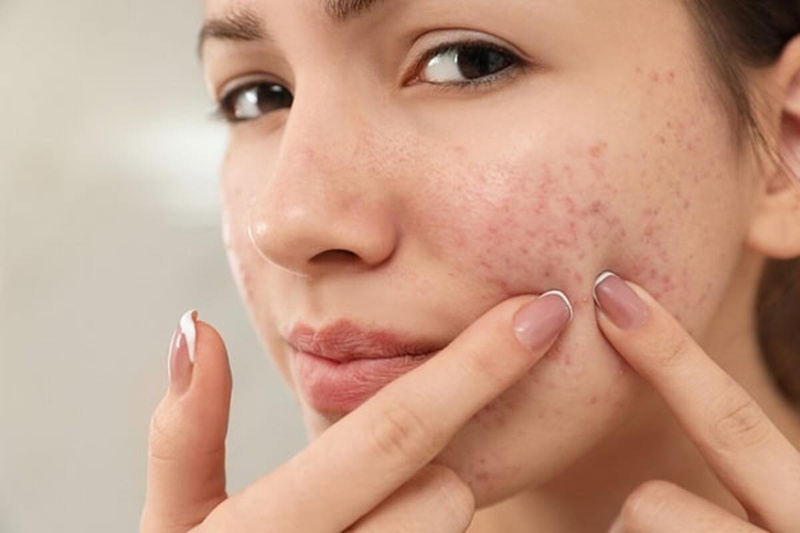 Phát ban mụn trứng cá là gì?2